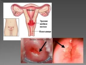 Как лечить кисту на шейке матки алоэ и медом