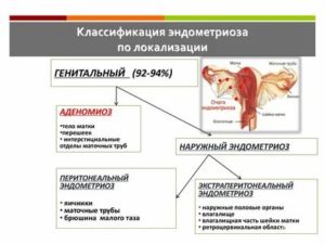 Наружный генитальный эндометриоз симптомы и лечение