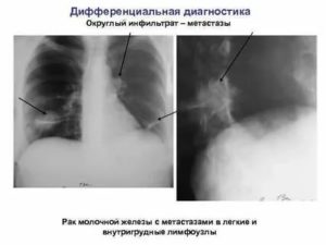 Метастазы в легкие при раке молочной железы рентген