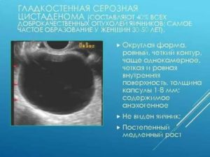 Чем отличается раковая опухоль от кисты яичника