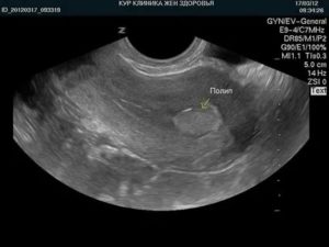 Может ли узи ошибаться с диагнозом полип эндометрия