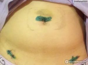 Может ли быть грыжа после лапароскопии кисты яичника