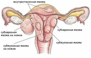 Можно ли крутить обруч при миоме матки и кисте яичника