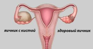 Можно ли заниматься сексом если обнаружена киста в яичнике