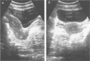 Почему узи матки делают на полный мочевой пузырь или нет