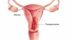 Как при гиперплазии проходит менструация