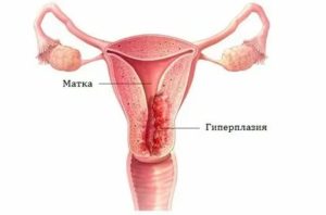 Как при гиперплазии проходит менструация