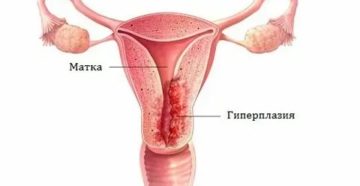 Как при гиперплазии проходит менструация