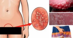 Впч и хроническая молочница