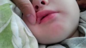 Помогает ли зеленка при молочнице у грудничка