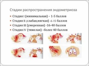 Наружный генитальный эндометриоз 2 степени что это