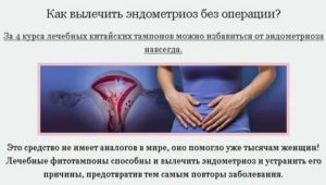 Кто вылечил эндометриоз китайскими тампонами