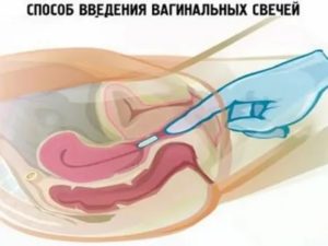 Когда можно идти в туалет после вагинальных таблеток