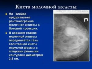 Какой врач лечит кисту молочной железы