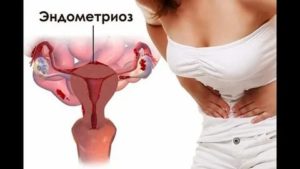 Лечебное голодание при эндометриозе