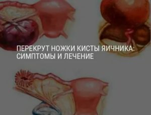 Как выходит киста яичника из организма признаки