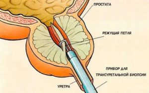 Биопсия предстательной железы тур-биопсия предстательной железы