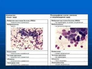 Цитологическая картина рака молочной железы