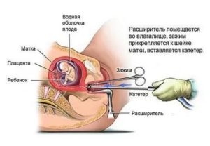 Когда начинаются месячные после неразвивающейся беременности