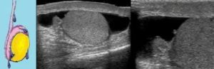 Узи образование в яичке у ребенка
