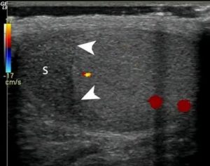 Инфаркт яичка на узи