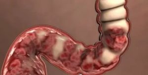 Можно ли заразиться кандидозом кишечника от больного