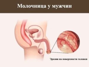 Эрозия головки и крайней плоти лечение мази