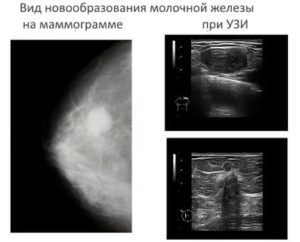 Чем отличается маммография молочных желез от узи молочных желез