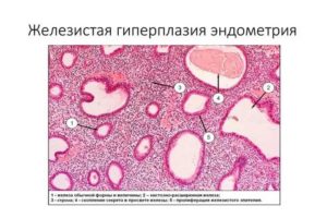 Эндометриоз железистая гиперплазия эндометрия фиброзная