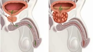 Хронический простатиты википедия
