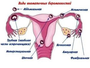 Могут ли не идти месячные при внематочной беременности на ранних сроках