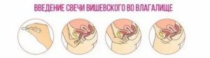 Мазь для введения во влагалище с тампоном