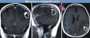 Симптомы метастазов в головной мозг при раке молочной железы