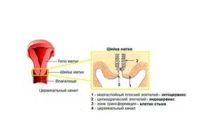 Цервикальный канал сомкнут это бесплодие