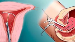 Препараты для восстановления матки после удаления спирали