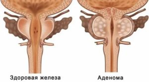 Ходьба при аденоме предстательной железы