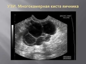 Что такое трехкамерная киста правого яичника