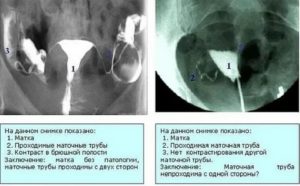 На какой день цикла можно делать узи маточных труб