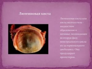 Что значит лютеиновая киста яичника