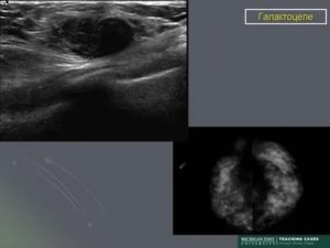 Галактоцеле молочной железы цитология