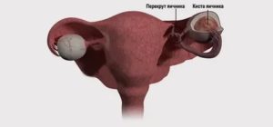 Что такое парацервикальная киста яичника