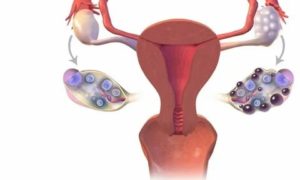 Внутренний эндометриоз мультифолликулярных яичников что это такое