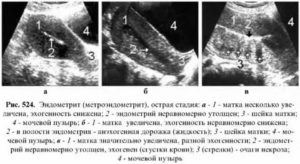 Что означает на узи эндометрий повышенной эхогенности