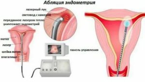 Абляция эндометрия при эндометриозе