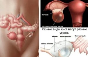 Как нащупать кисту яичника у женщин