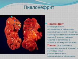 Кандидозный пиелонефрит симптомы