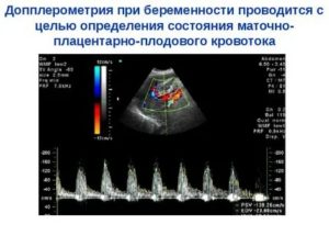 Маточно плацентарный кровоток при узи