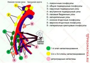 Метастазы в лимфоузлах при раке шейки матки прогноз выживаемости