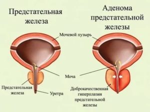 Излечима ли аденома предстательной железы мнение ученых