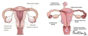 Когда удаляют матку при миоме идут месячные или нет